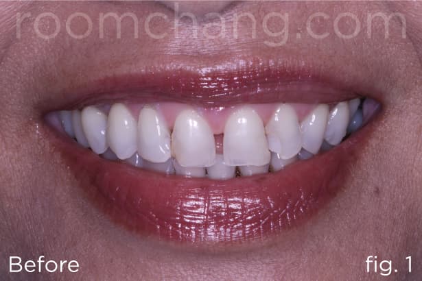 Before treatment — spacing and discolouration on upper anteriors