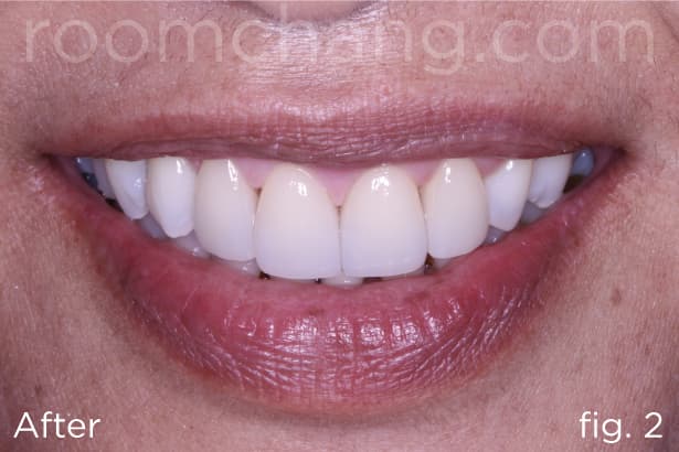After treatment — four E-Max crowns cemented