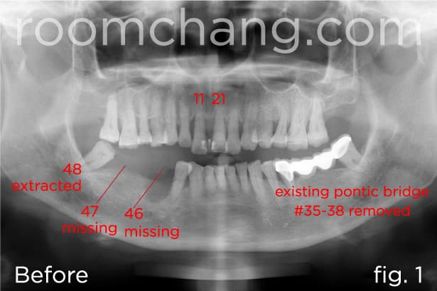 Before treatment — mobile upper teeth and receding gums
