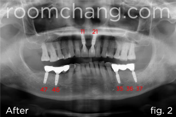Implant placement — upper and lower arch