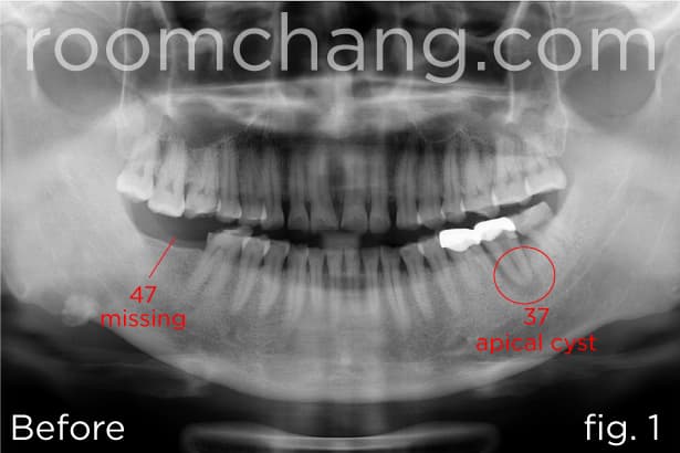 Clinical view — implant placement