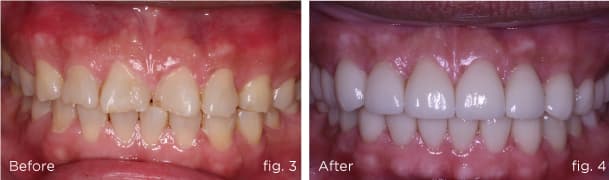 Before and after comparison
