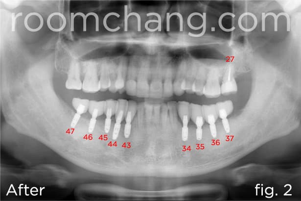 After treatment — 15 E-Max crowns cemented