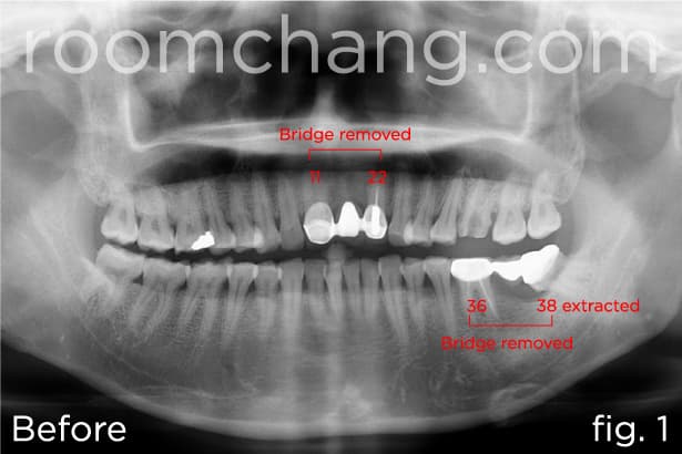 Before treatment — anterior view