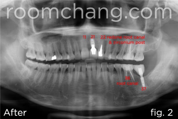 After treatment — E-Max crown restorations