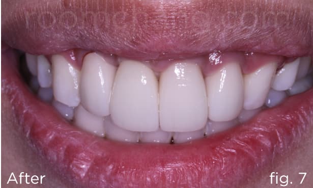 Final result — profile and bite fully restored