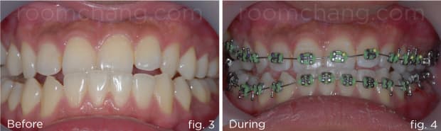 Dental alignment — before bilateral crossbite correction