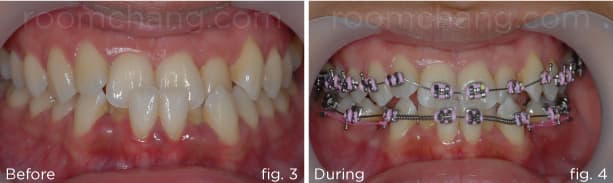 Profile view — after treatment, crossbite corrected