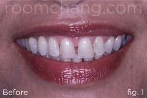 Before and after — E-Max Crown Smile Makeover