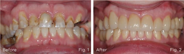Before and after — Full Mouth Reconstruction