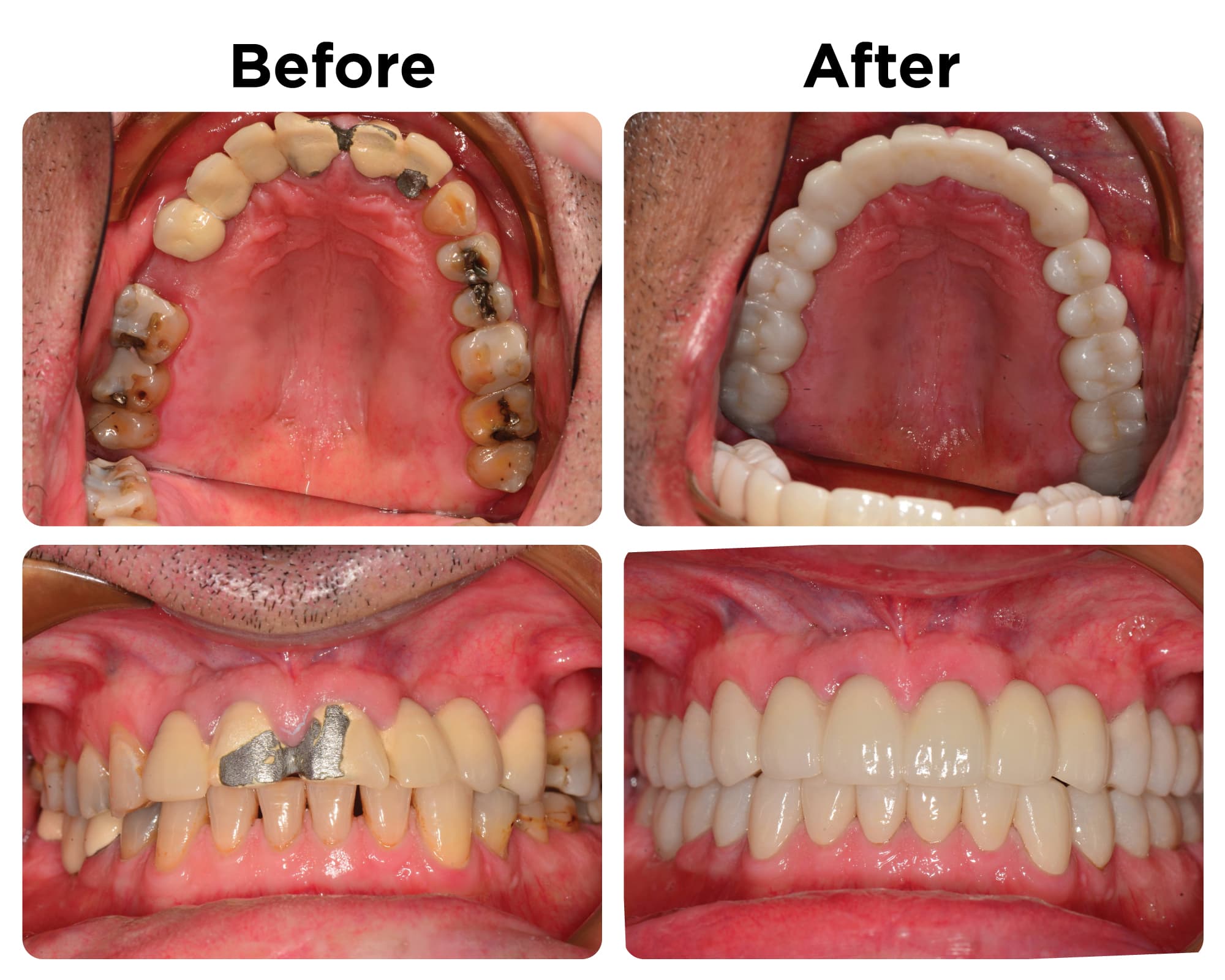 Full Mouth Reconstruction treatment at Roomchang Dental Hospital