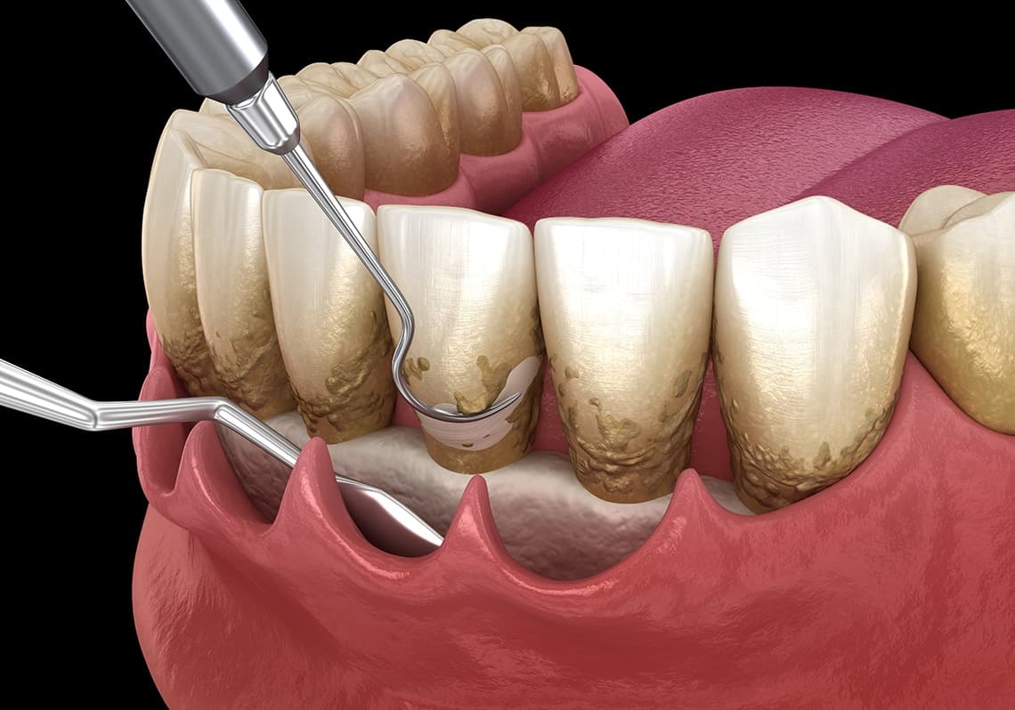 Periodontal Dentistry at Roomchang Dental Hospital