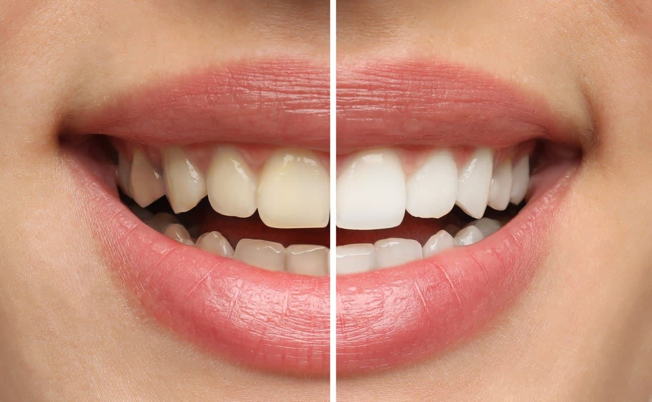 Teeth Whitening at Roomchang Dental Hospital